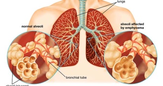 Bệnh phổi tắc nghẽn mãn tính (COPD) giai đoạn cuối nguy hiểm như nào?